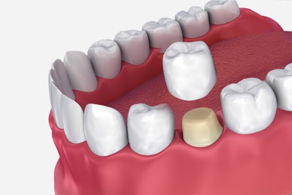 Zahnkrone in Pristina