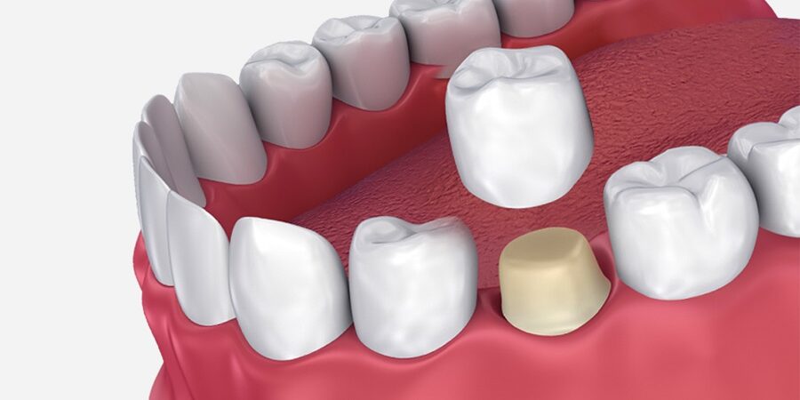 Zahnkrone in Pristina